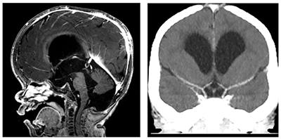 Case Report: Cerebral Revascularization in a Child With Mucopolysaccharidosis Type I